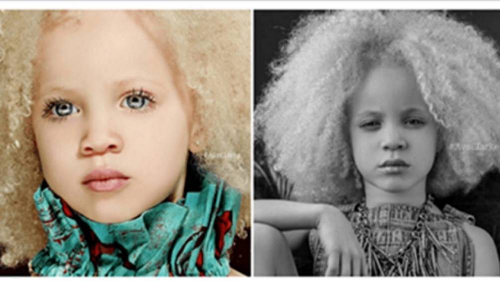 Девочка-альбинос смогла не только приспособится к жизни, но и стать моделью