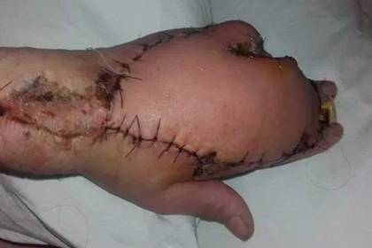 Женщина получила царапину от кота, лишилась пальца и едва не умерла