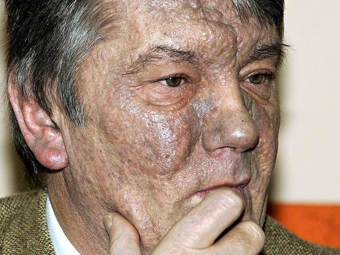 Легенда об отравлении экс-президента Украины Ющенко оказалась ложью