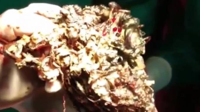 В Индии хирурги извлекли из желудка девушки 1,6 кг золотых украшений