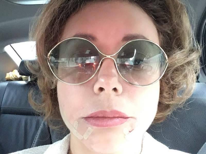 "Лицо поехало": 44-летняя Божена Рынска перекроила себя ради селфи