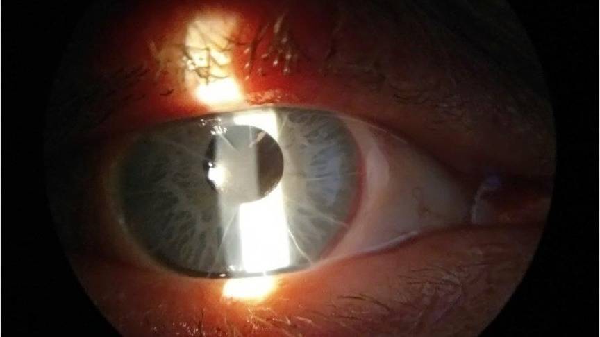 Кировские офтальмологи освоили новый метод операций на глазах
