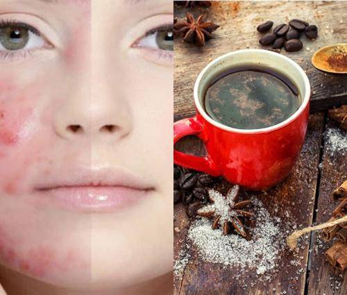 Кофе вызывает угри: Косметологи назвали неожиданную причину проблемной кожи