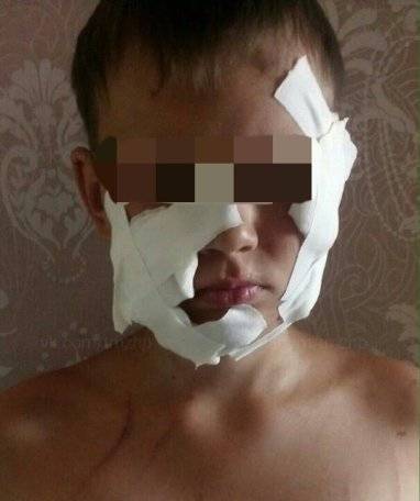«Наложили швы на лицо под наркозом»: еще одно нападение собаки на ребенка произошло в Башкирии