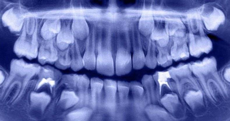 Изо рта индийского мальчика удалил больше 500 зубов