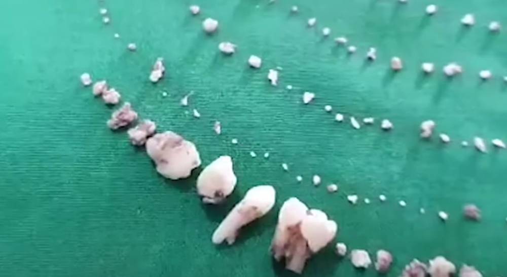 Во рту у ребенка обнаружили 526 лишних зубов