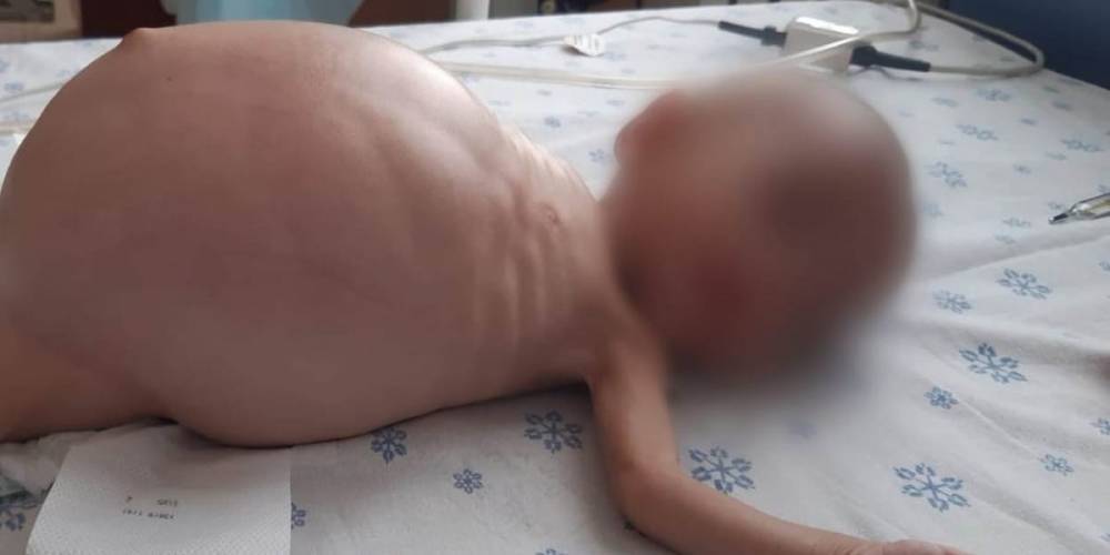 Огромную опухоль удалили врачи у годовалой девочки в Актау (фото)