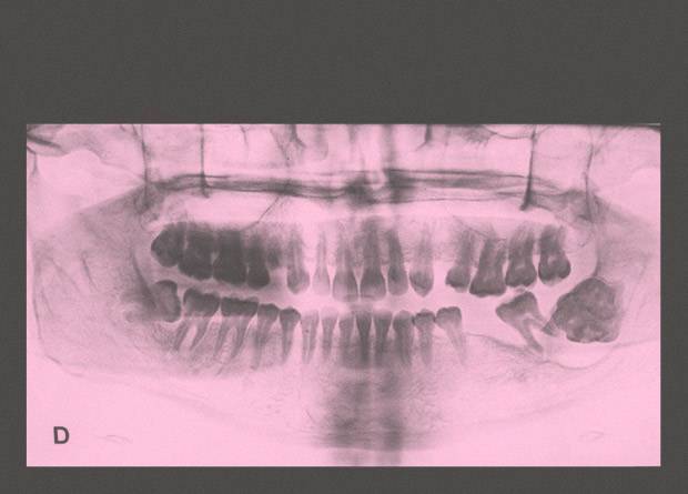 У семилетнего мальчика удалили из нижней челюсти опухоль с 526 «зубами»