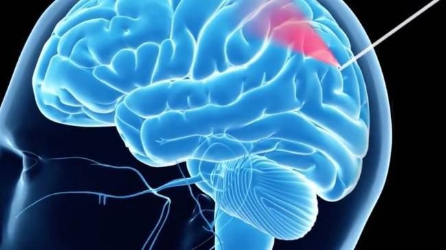 В России разработан стопроцентный метод биопсии опухоли мозга — Технологии, Новости России
