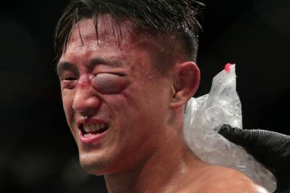 Фото гематомы бойца UFC испугало пользователей сети
