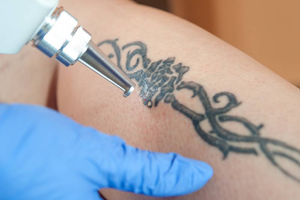 Новый метод удаления татуировок в Израиле: цены и побочные действия