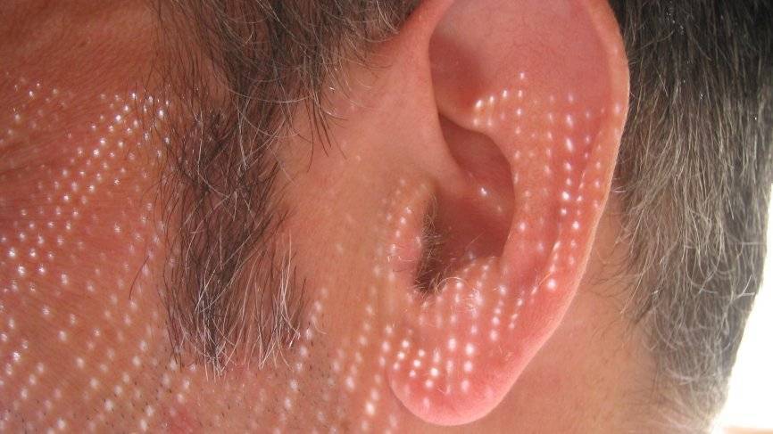 Медики рассказали, о каких болезнях свидетельствует шум в ушах