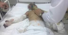 Избитой девочке из Ингушетии ампутировали руку