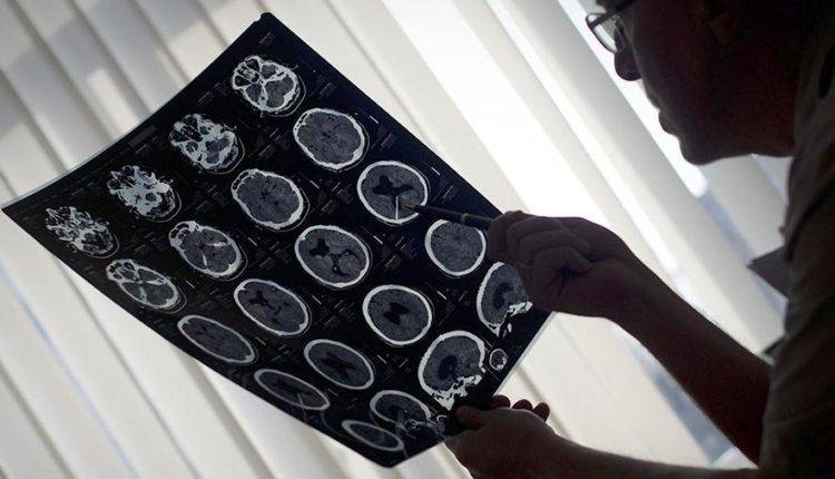 Врач назвал главные симптомы рака мозга - newtvnews.ru