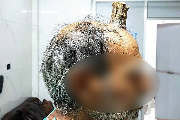 Хирурги вырезали индийцу 10-сантиметровый «дьявольский» рог