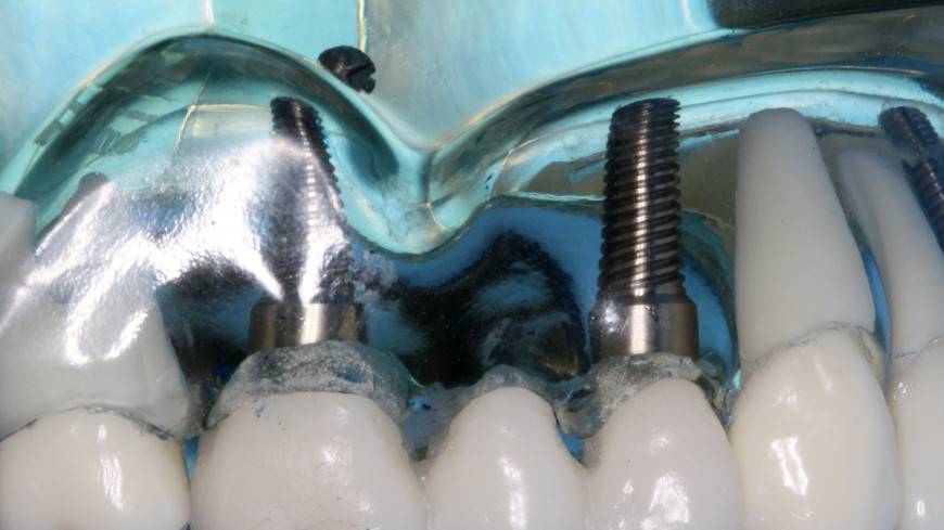 Российские стоматологи рассказали об опасности зубных имплантатов