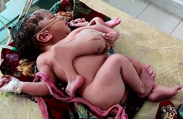 В Индии родилась девочка с четырьмя ногами и тремя руками