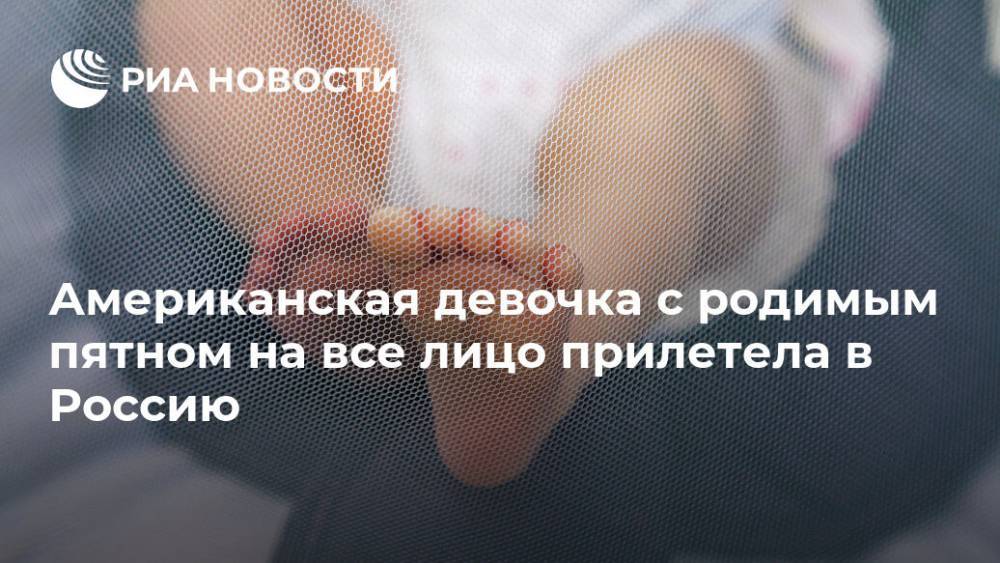 Американская девочка с родимым пятном на все лицо прилетела в Россию