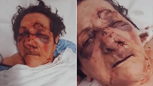 Сын 86-летней женщины выложил в соцсети шокирующие фото своей матери, утверждая, что ее избили и сломали нос в доме престарелых