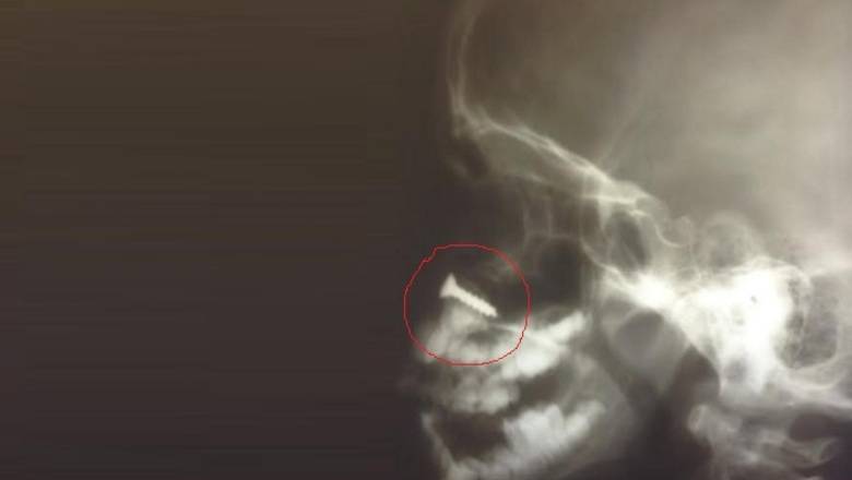 Год не замечали: подмосковные врачи извлекли шуруп из носа пятилетней девочки