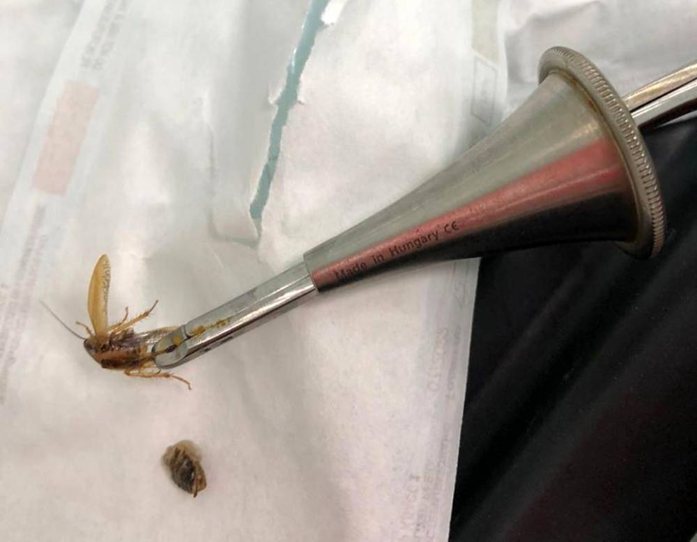 Из уха достали таракана: в больнице рассказали подробности лечения кемеровчанина