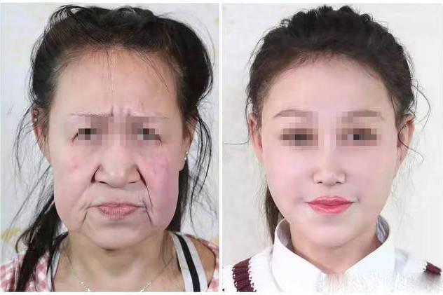 Девочке с лицом «бабушки» сделали пластическую операцию