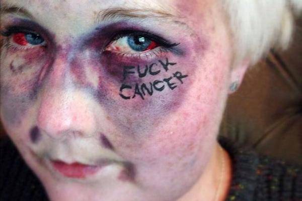 Женщина, которая написала «F *** рак» на своем лице, умерла от лейкемии