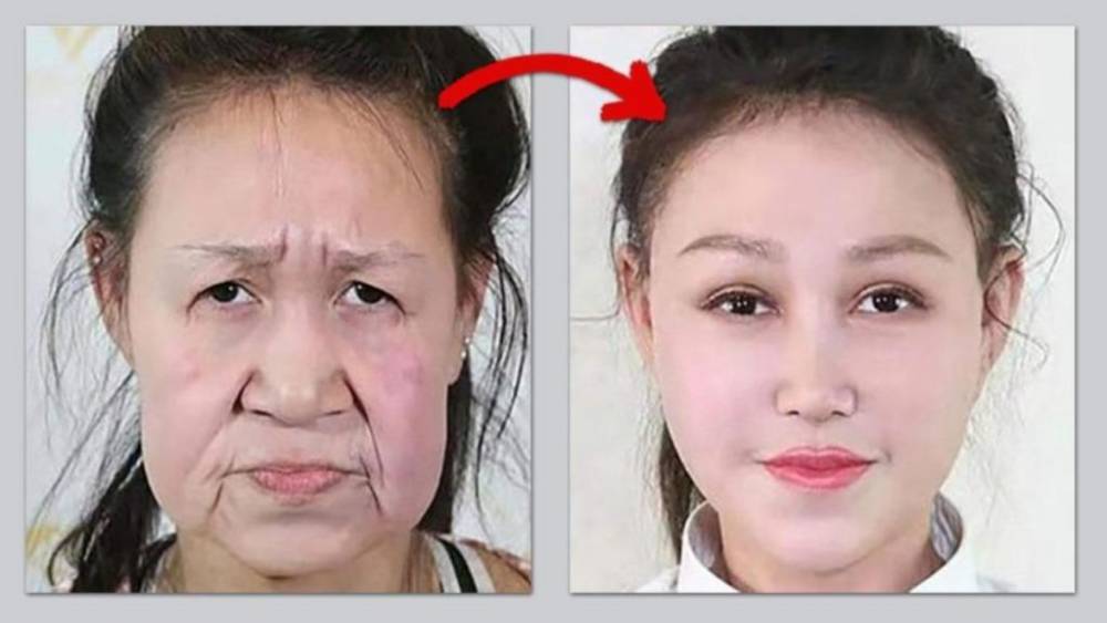 Хирурги подарили 15-летней школьнице-«бабушке» новое лицо