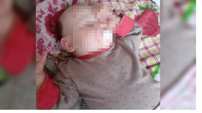 Девочке с родимым пятном на половину тела сделали первую операцию в Петербурге
