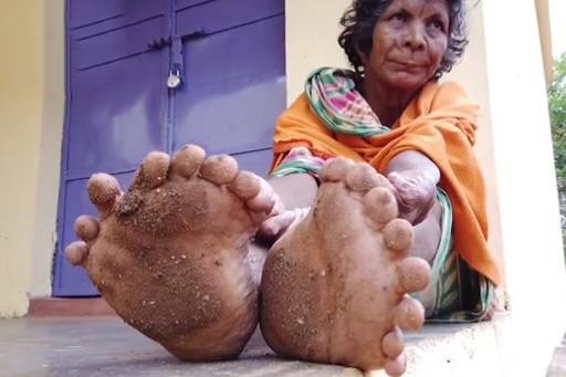 Индианка с рекордным числом пальцев на ногах попала в книгу рекордов Гиннесса