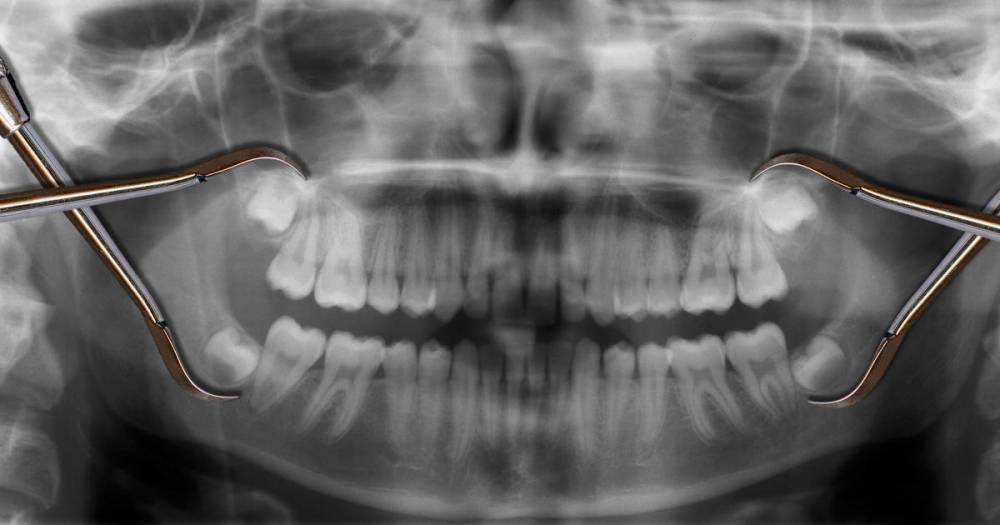 Ученые заявили, что все больше людей рождается без зубов мудрости