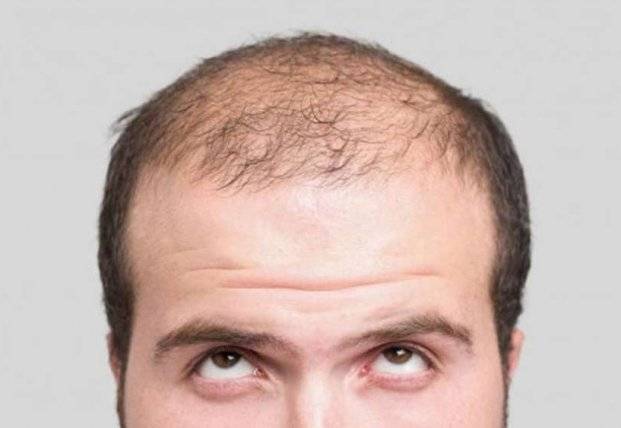 Ученые узнали, как предотвратить выпадение волос