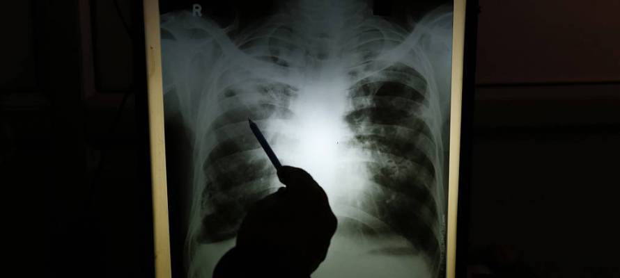 Десятки новых случаев внебольничной пневмонии зарегистрированы в Карелии