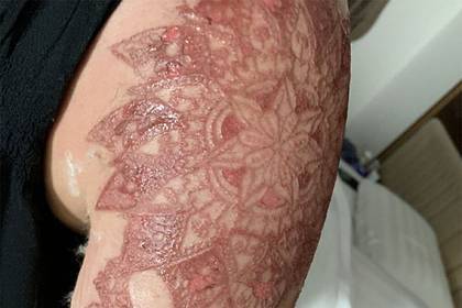 Туристка сделала временную татуировку и осталась с химическим ожогом