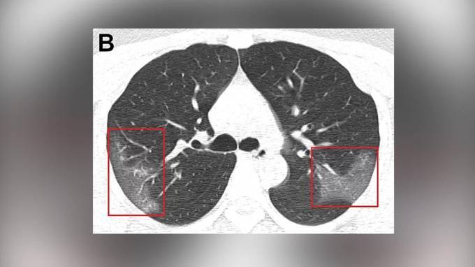 Китайские медики показали снимки легких, которые поражены коронавирусом