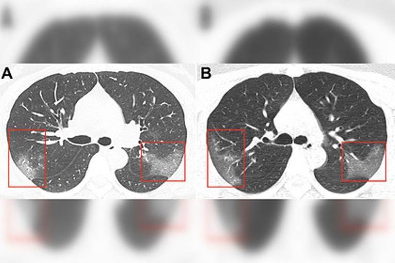 Медики показали снимки поражённых коронавирусом лёгких