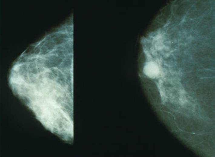 Маммолог назвала причины развития рака молочной железы
