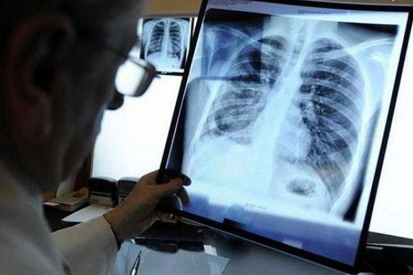 В Казахстане смертность от туберкулеза снизилась в 5,6 раз