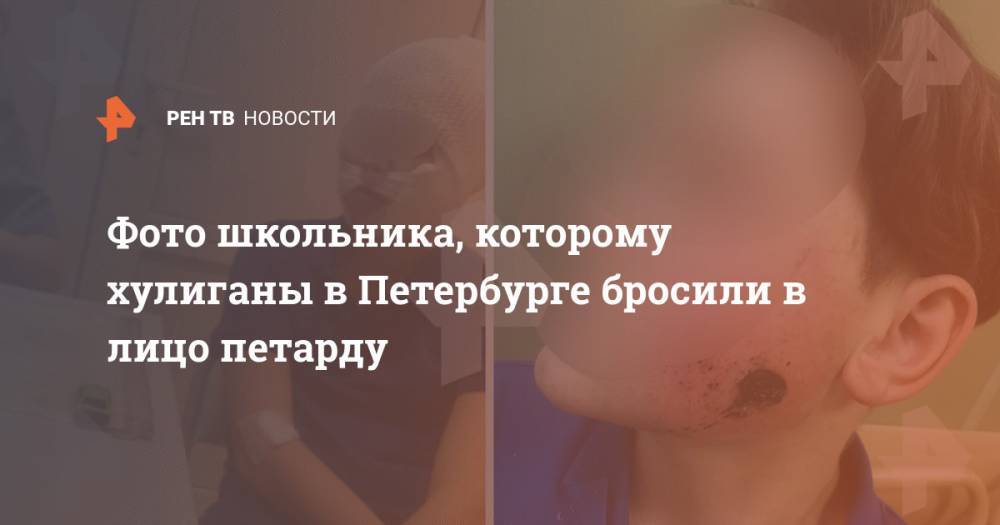 Фото школьника, которому хулиганы в Петербурге бросили в лицо петарду