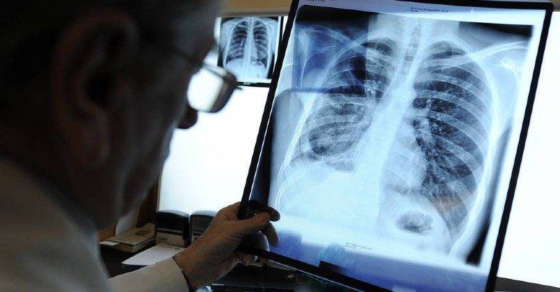 Литва и Латвия стали лидерами ЕС по смертности от туберкулеза