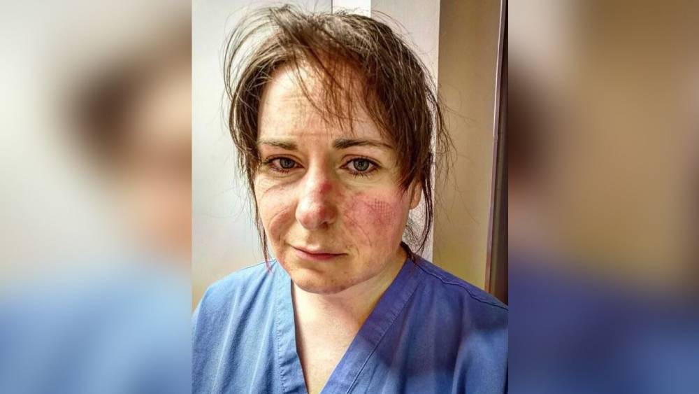Медсестра из Британии показала лицо после 13-часовой смены в защитном костюме