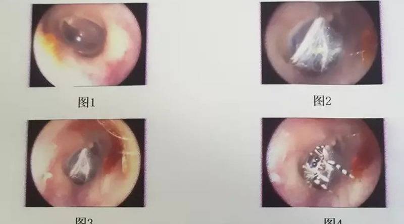 Женщина обратилась к медикам с жалобами на боль в ухе: оказалось, в слуховом канале неделю жил паук - usa.one - Китай