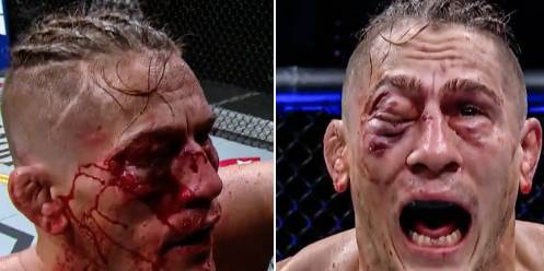 У бойца UFC «закрылся» глаз из-за страшной гематомы (видео)