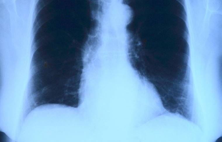 ИИ обработал 30 тысяч КТ-снимков лёгких в Москве