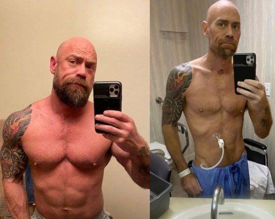 Выживший после коронавируса мужчина поделился шокирующими фото изменений своего тела