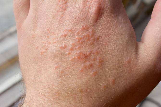Высыпания на коже — новый cимптом коронавируса (COVID-19)