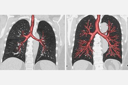 Выяснено происхождение рака легких у некурящих