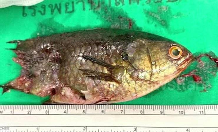 Еле спасли. В Таиланде рыба-ползун заползла в горло подростку и застряла