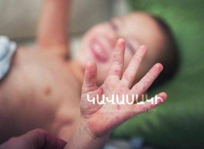 В Армении у 4-летнего пациента с коронавирусом был диагностирован детский многосистемный воспалительный синдром