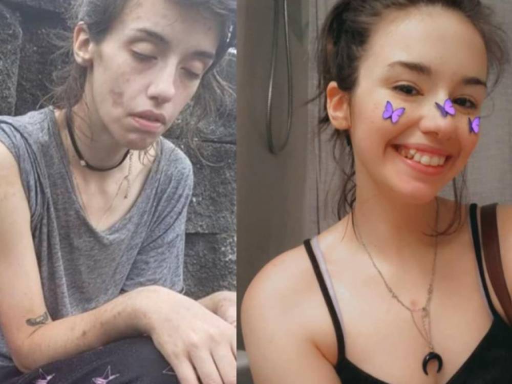 Реабилитация возможна, и она того стоит: Наркозависимая девушка показала фото «до» и «после»